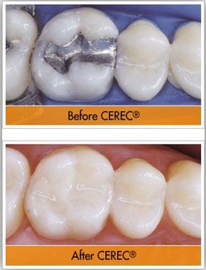 CEREC before and after | Dentist Wantirna South
