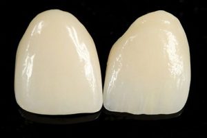 Ceramic Veneers Shell | Dentist Wantirna South