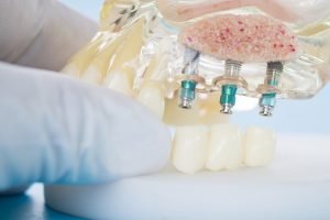 Dental Implants in Wantirna South Should You Shop Around