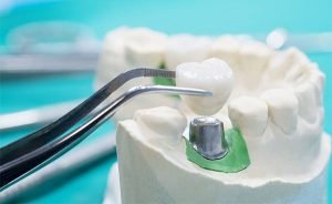 lost dental restorations wantirna south