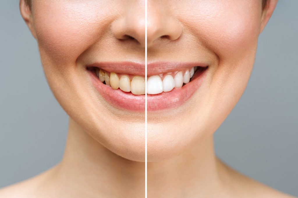 are you considering tooth whitening? here are some things to think about